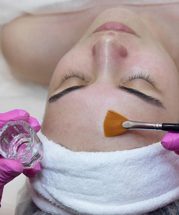 Traitement à l'acide glycolique Laval